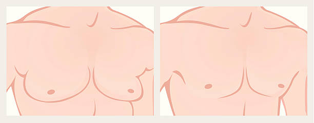 plastic-surgeon-for-gynecomastia